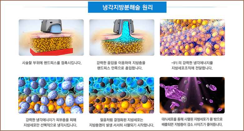 냉각지방분해술 원리