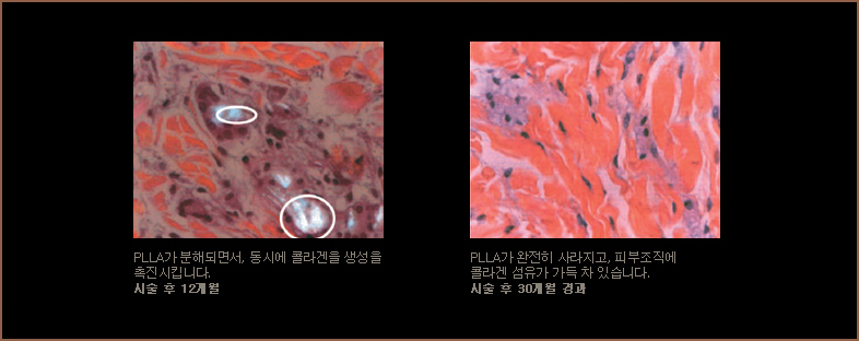 PLLA가분해되면서, 동시에 콜라겐을 생성을 촉진시킵니다(시술 후 12개월)/PLLA가 완전히 사라지고, 피부조직에 콜라겐 섬유가 가득차 있습니다.(시술 후 30개월 경과)