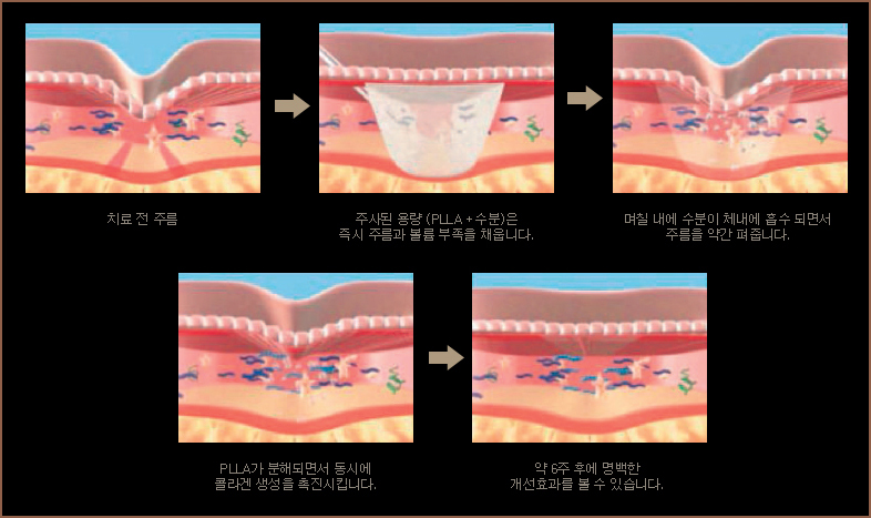 치료 전 주름/주사된 용량은 죽시 주름과 볼륨 부족을 채웁니다/며칠 내에 수분이 체내에 흡수 되면서 주름을 약간 펴줍니다/PLLA가 분해되면서 동시에 콜라겐 생성을 촉진시킵니다/약 6주 후에 명백한 개선효과를 볼 수 있습니다.